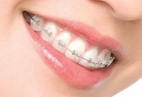 Braces Ortho Braces Ortho