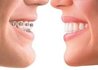 Ortho Braces Faqs Ortho Braces Faqs