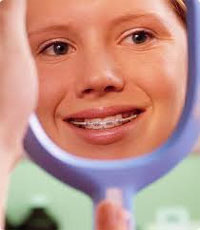 Types of Braces Types of Braces