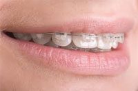 What are orthotics braces What are orthotics braces